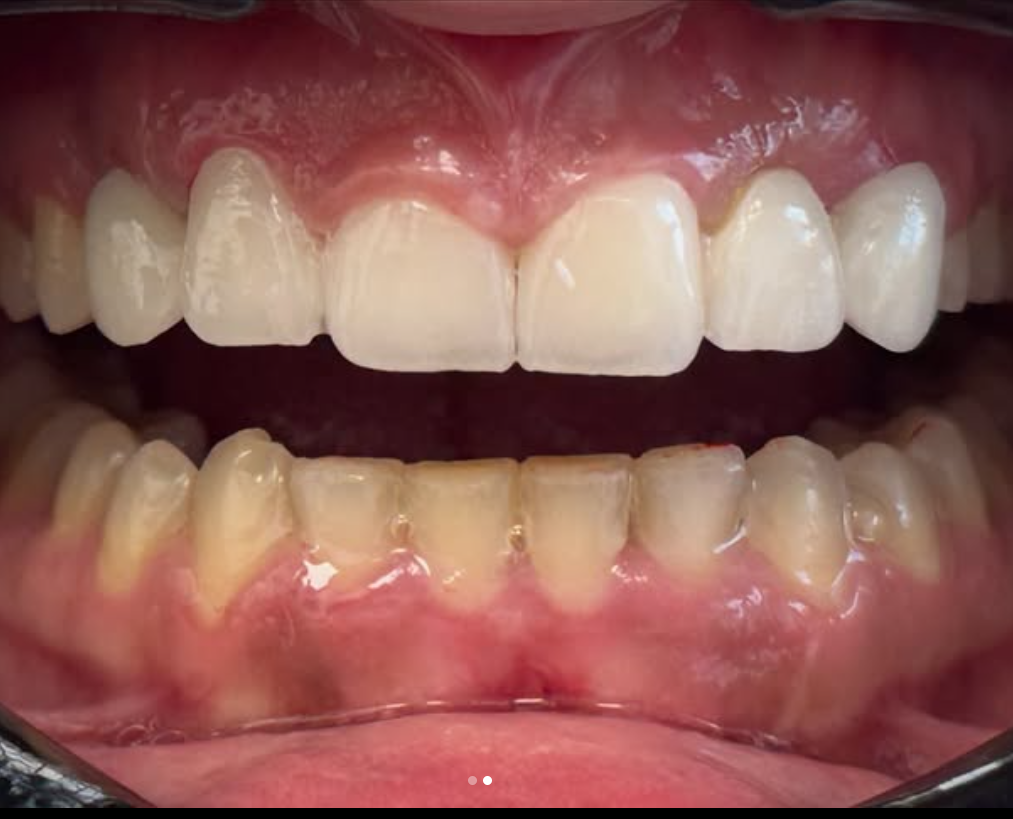 Pas trajtimit — implant dentar