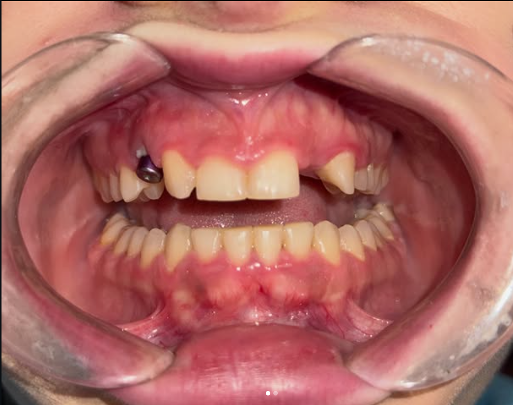 Para trajtimit — implant dentar