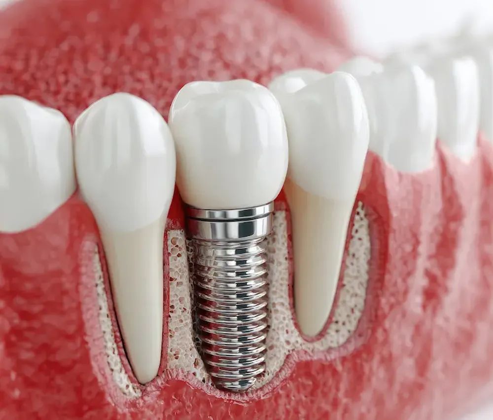 Implante Dentare
